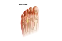 Midfoot Pain Syndrome or Morton’s Neuroma