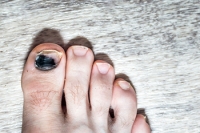 Managing Toenail Injuries