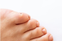 Why Foot Corns Are Painful