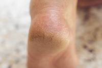 Why Skin Fissures Cause Cracked Heels