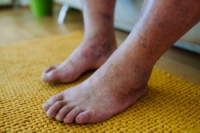 Diabetic Foot Problems